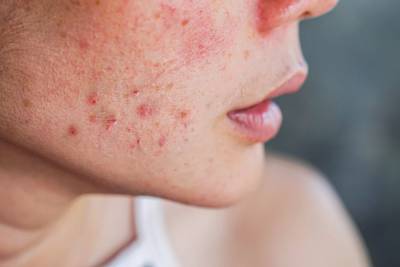 Acne: profissional explica causas, efeitos e tratamentos eficazes