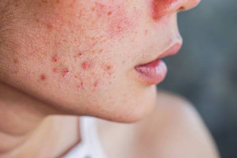 Acne: profissional explica causas, efeitos e tratamentos eficazes