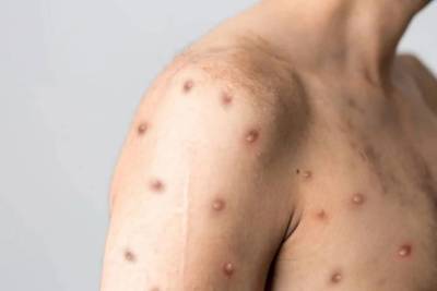Santa Catarina registra 16 casos de Mpox em 2024; confira os métodos de prevenção