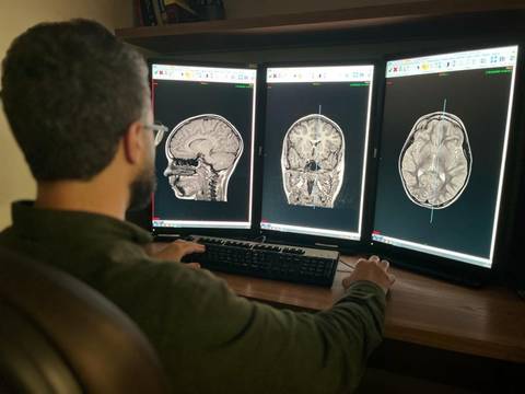 Ressonância Magnética: exame é fundamental para avaliação de casos de epilepsia