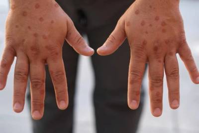 Mpox no Sul de Santa Catarina: monitoramento e vigilância continuam ativos