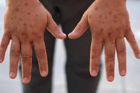 Mpox no Sul de Santa Catarina: monitoramento e vigilância continuam ativos