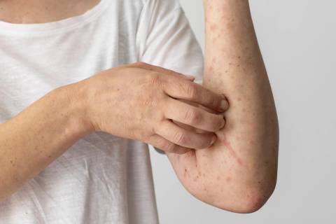 Dermatologista alerta para aumento dos casos de dermatite durante o inverno
