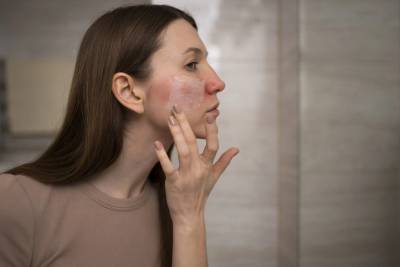 Rosácea: condição de pele piora no inverno e pode ser confundida com acne