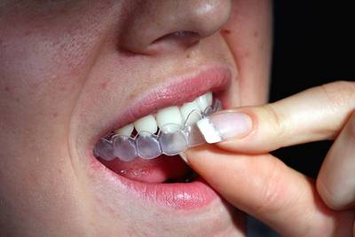 Aumenta procura para fazer clareamento dental