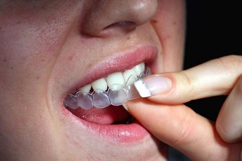 Aumenta procura para fazer clareamento dental