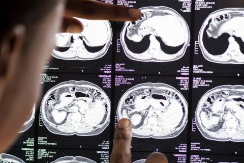 Epilepsia além da convulsão: especialista revela cinco sinais pouco conhecidos da doença