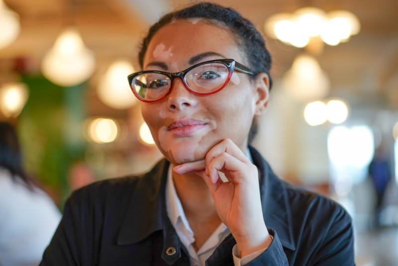 Dia Mundial do Vitiligo: preconceito é a maior luta a ser enfrentada pelos pacientes